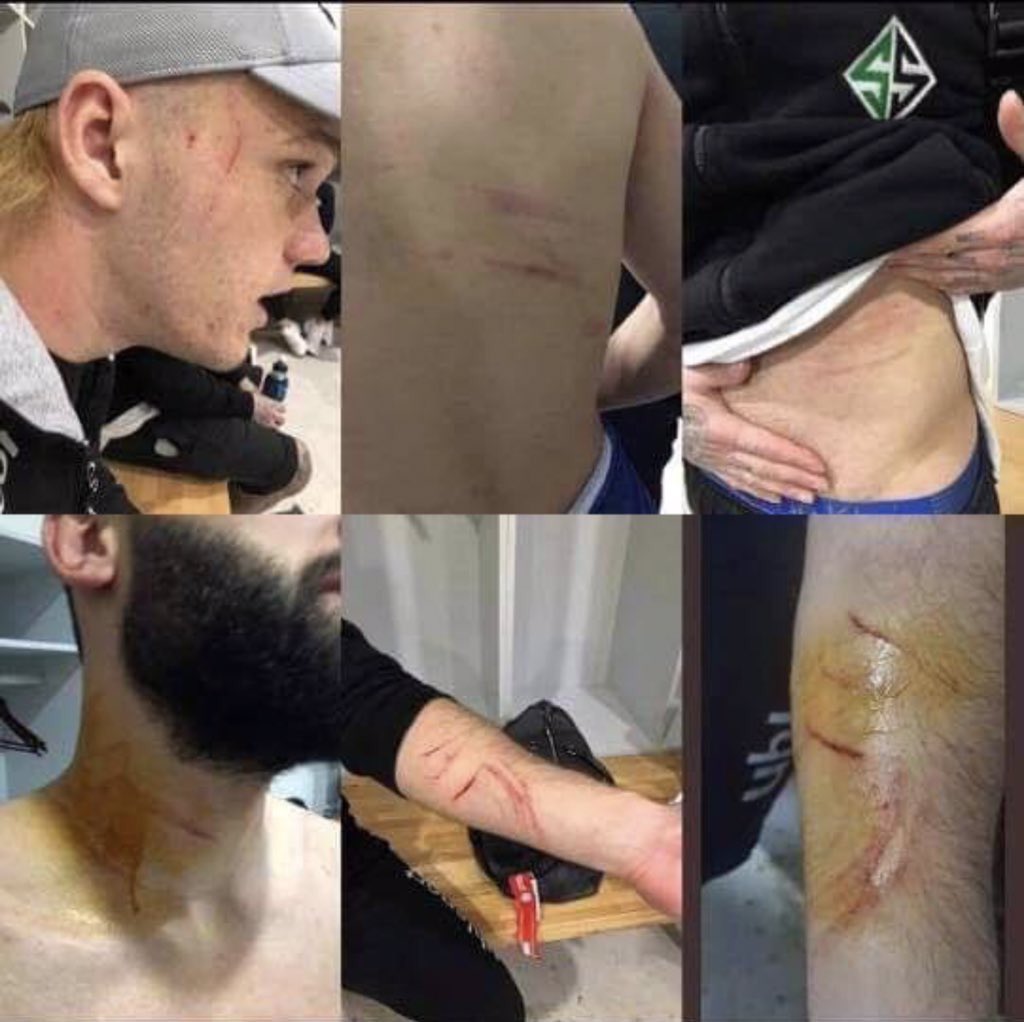 В Турции футболист изрезал соперников пронесенной на поле бритвой  